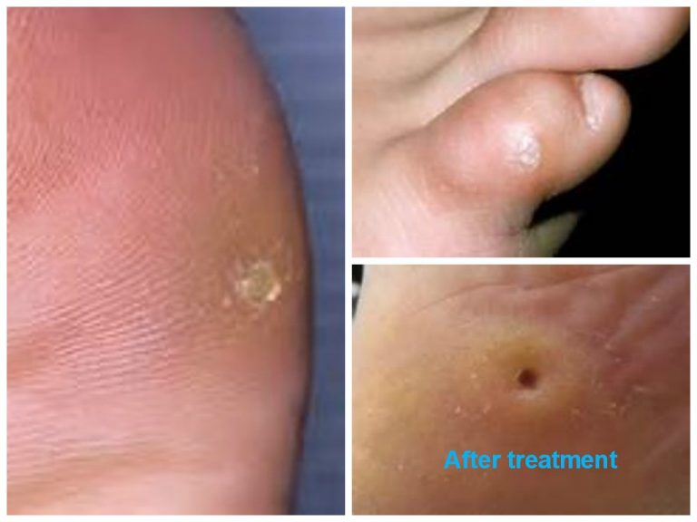 callus-and-corns-what-is-the-difference-foot-factor-podiatry